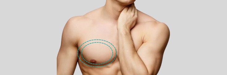 Get Rid of Man Boobs with Male Breast Reduction Treatment
