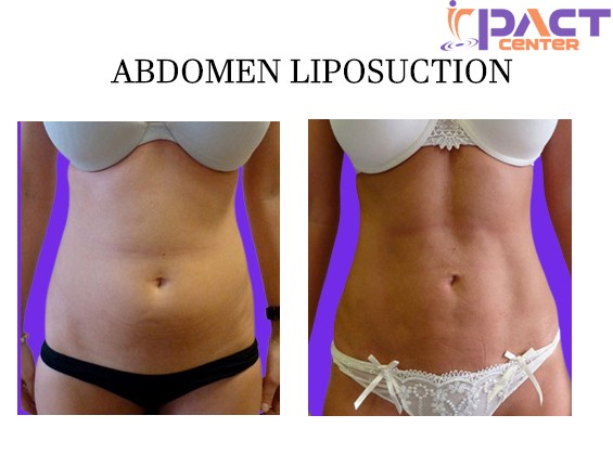 abdomen liposuction