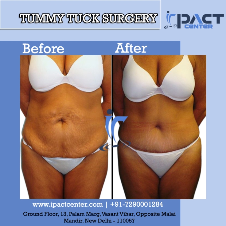 Get a Tummy Tuck Surgery and Say Goodbye to Your Belly Bulge